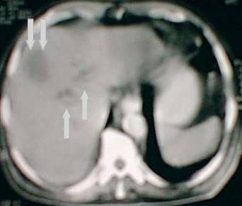 mhtml:file://C:\Documents%20and%20Settings\Yanet%20Acosta%20Piedra\My%20Documents\Medicina\Oriol\Ampuloma\Fot%20del%20mes%20ADENOCARCINOMA%20DE%20LA%20AMPOLLA%20DE%20VATER%20(AMPULOMA).mht!http://www.intermedicina.com/fotos/foto_oct00_B.jpg